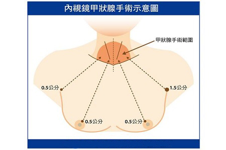 脖子不留疤 從乳暈切除甲狀腺腫瘤