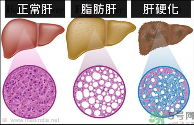 得了脂肪肝該怎么治？脂肪肝對人體危害有多大？