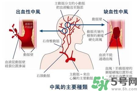 腦中風(fēng)是什么？腦中風(fēng)的癥狀？