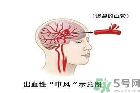 腦中風(fēng)的護(hù)理措施？腦中風(fēng)的飲食護(hù)理？