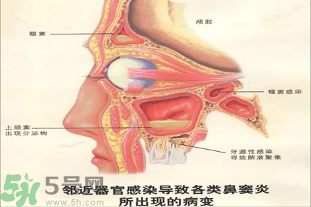 鼻竇炎是什么？鼻竇炎的癥狀有哪些？