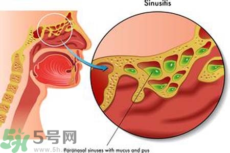 鼻竇炎的護(hù)理措施？鼻竇炎的飲食護(hù)理？