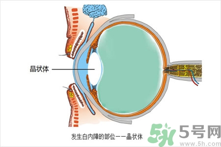 白內(nèi)障的護(hù)理措施是什么？白內(nèi)障的飲食護(hù)理有哪些？