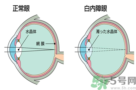 白內(nèi)障治療方法是什么？白內(nèi)障可以用什么藥物治療？