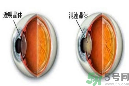 白內(nèi)障治療方法是什么？白內(nèi)障可以用什么藥物治療？