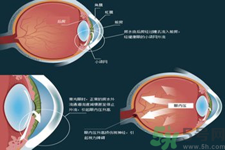 青光眼的高發(fā)人群有哪些？如何預(yù)防青光眼？