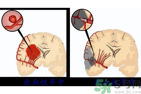 腦出血的發(fā)病因素是什么？腦出血的并發(fā)癥有哪些？