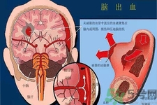 腦出血的發(fā)病因素是什么？腦出血的并發(fā)癥有哪些？