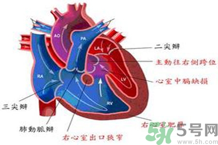 先天性心臟病發(fā)病原因是什么？