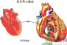 先天性心臟病發(fā)病原因是什么？