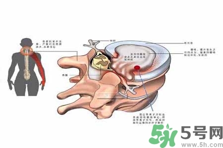 為什么年輕人容易得頸椎??？頸椎病嚴(yán)重的癥狀有哪些？