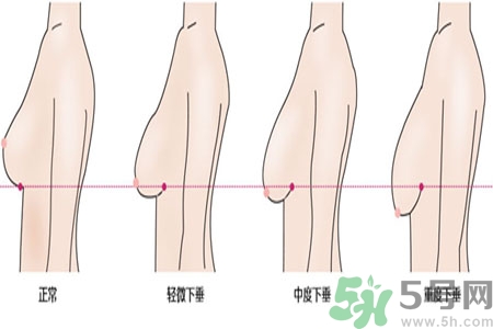 ?女性乳房下垂的原因是什么？女性乳房下垂的分類有哪些？