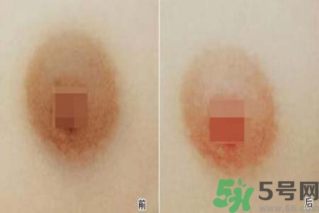 乳頭發(fā)黑怎么辦？怎么樣可以使乳頭變白？