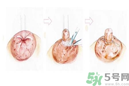 乳頭內(nèi)陷怎么回事？乳頭內(nèi)陷的原因是什么？