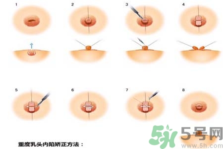 乳頭內(nèi)陷怎么回事？乳頭內(nèi)陷的原因是什么？