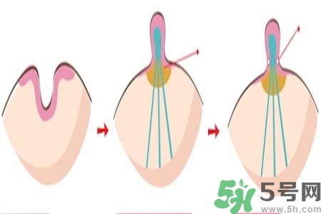 乳頭內(nèi)陷怎么辦？乳頭內(nèi)陷的癥狀有哪些？