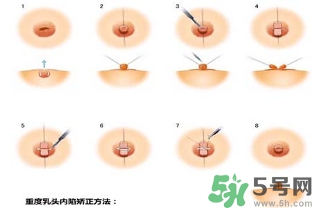 乳頭內(nèi)陷怎么辦？乳頭內(nèi)陷的癥狀有哪些？