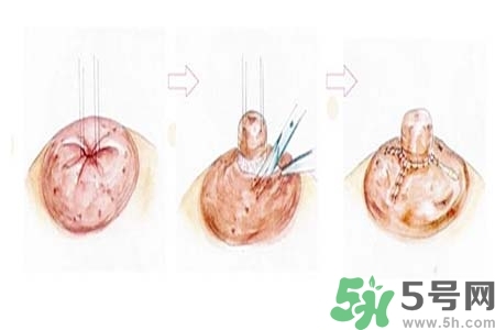 乳頭內(nèi)陷怎么辦？乳頭內(nèi)陷的癥狀有哪些？