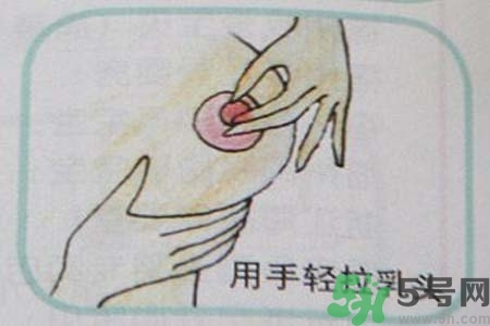 乳頭內(nèi)陷怎么辦？乳頭內(nèi)陷的癥狀有哪些？