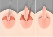 乳頭內(nèi)陷怎么辦？乳頭內(nèi)陷的癥狀有哪些？