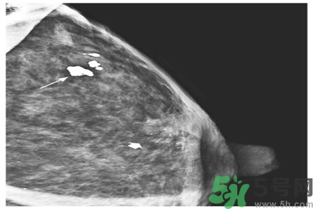 乳腺增生鈣化是什么？乳腺鈣化的癥狀有哪些？