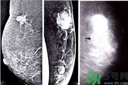 乳腺增生鈣化是什么？乳腺鈣化的癥狀有哪些？