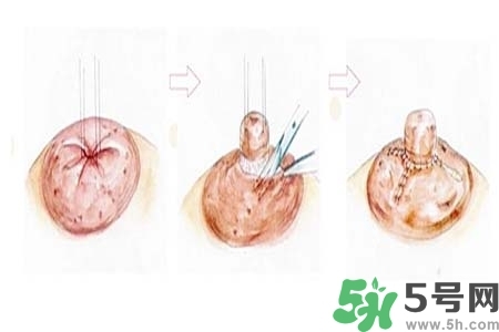 乳頭內(nèi)陷怎么矯正？乳頭內(nèi)陷矯正方法是什么？