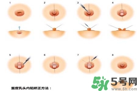 乳頭內(nèi)陷怎么矯正？乳頭內(nèi)陷矯正方法是什么？