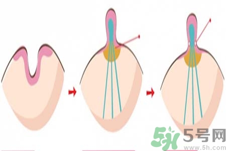 乳頭內(nèi)陷矯正需注意什么？乳頭內(nèi)陷如何預(yù)防？