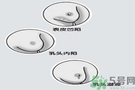 乳頭內(nèi)陷矯正需注意什么？乳頭內(nèi)陷如何預(yù)防？