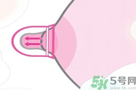 乳頭內(nèi)陷可以拔罐嗎？乳頭內(nèi)陷需要手術(shù)治療嗎？