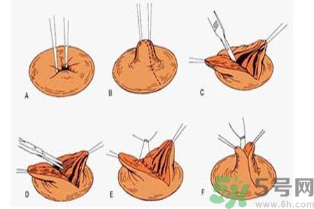 乳頭內(nèi)陷可以拔罐嗎？乳頭內(nèi)陷需要手術(shù)治療嗎？