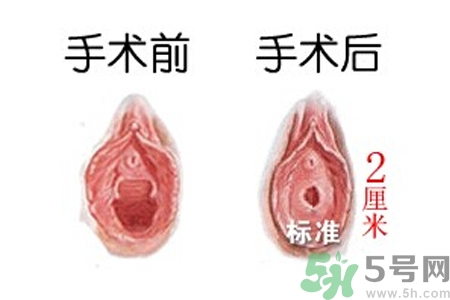 什么人不能做處女膜修補術(shù)？處女膜修補術(shù)會留疤嗎？