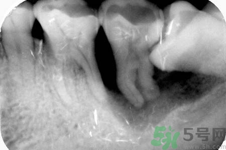 拔智齒一顆多少錢？拔除智齒收費(fèi)多少？