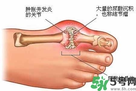 引發(fā)痛風(fēng)的原因是什么？痛風(fēng)病人飲食需注意什么好？