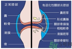 骨關(guān)節(jié)炎能治好嗎？骨關(guān)節(jié)炎平時注意事項