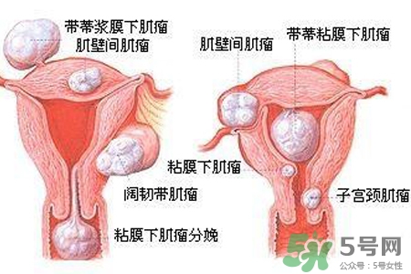 子宮小會影響生育嗎？子宮小會導(dǎo)致不孕嗎？