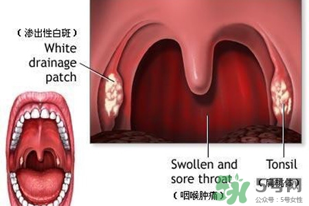 咽喉炎吃什么藥最好？咽喉炎吃什么藥好的快？