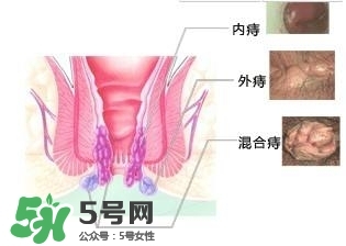 痔瘡吃什么藥效果好？痔瘡吃什么藥好得快？