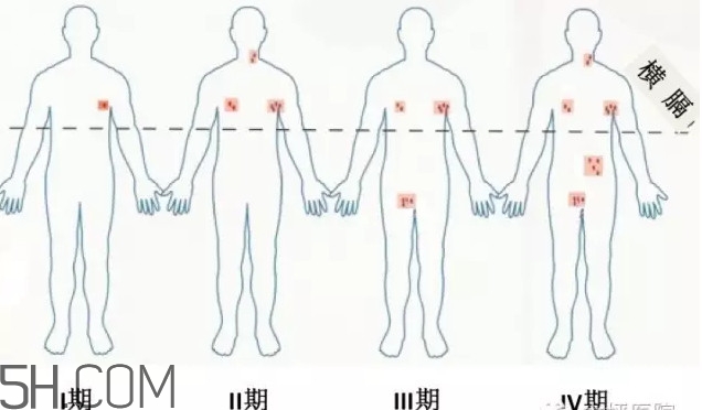 淋巴癌是怎么回事？淋巴癌如何診斷