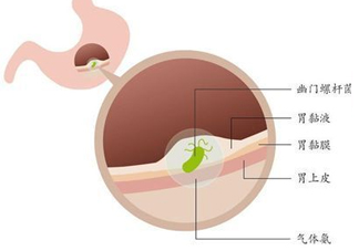 幽門螺桿菌的癥狀有哪些表現(xiàn)？幽門螺旋菌怎么治療