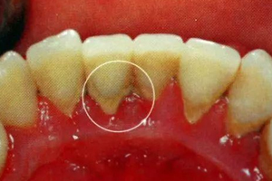 牙結(jié)石能自動脫落嗎？除了洗牙別無他法