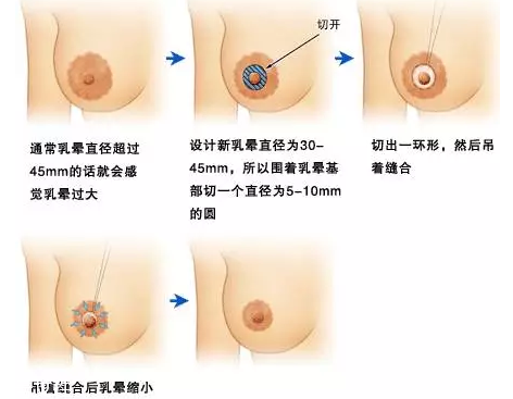 乳暈縮小術怎么做？乳暈縮小術知識全解