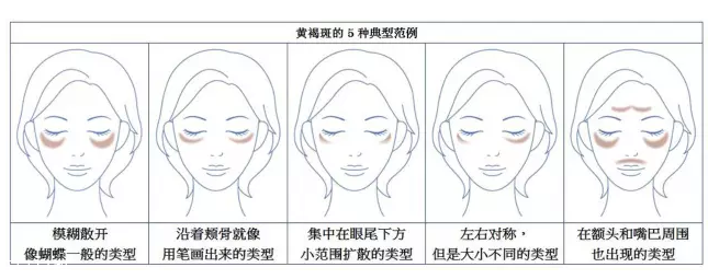 祛斑美白什么產(chǎn)品最有效 日常祛斑小妙招