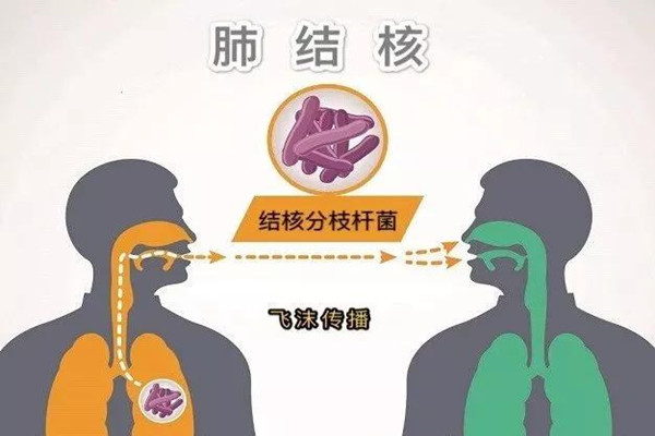 肺結核會引起淋巴結腫大嗎 肺結核會引起胸腔積液嗎