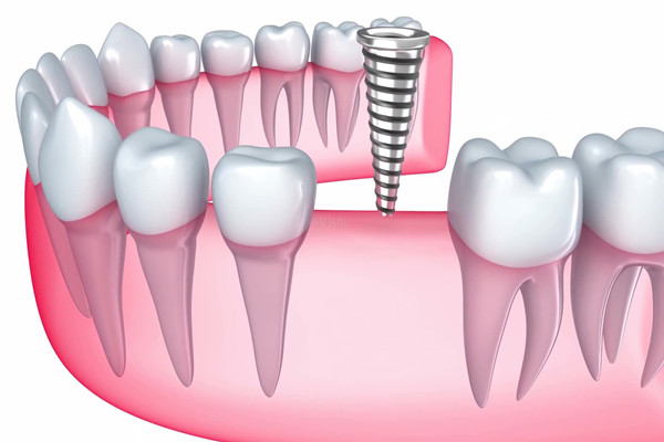 種植牙如何護(hù)理 種植牙會有后遺癥嗎