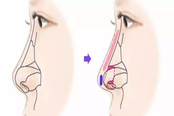 隆鼻可以維持一輩子嗎 隆鼻是怎么操作的
